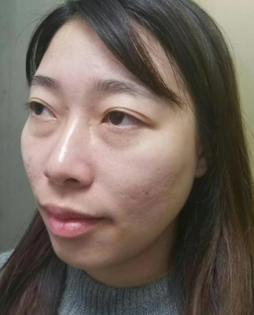 去眼袋手术