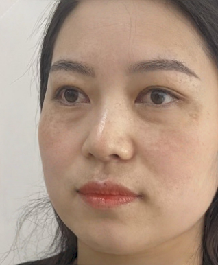 去眼袋手术