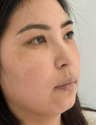 去眼袋手术