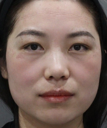 去眼袋手术
