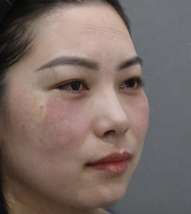 去眼袋手术