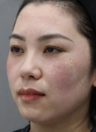 去眼袋手术