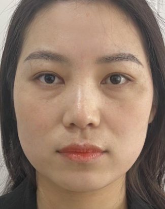 去眼袋手术