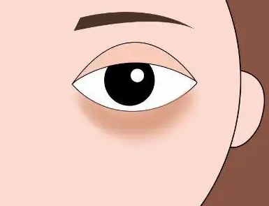 眼袋