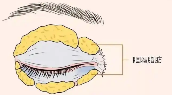 眼袋