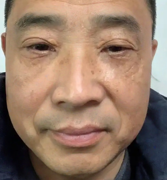 去眼袋手术