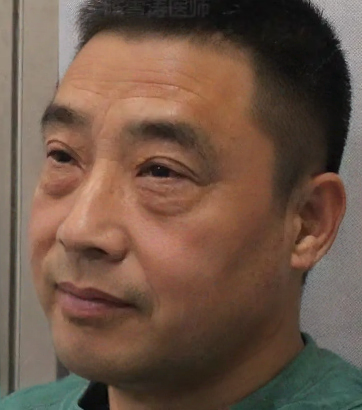 去眼袋手术