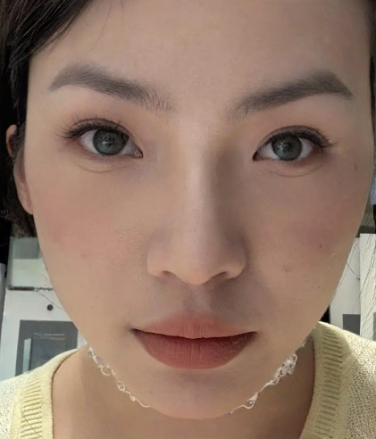 去眼袋手术