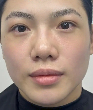 去眼袋手术