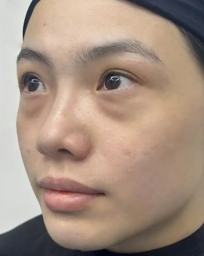 去眼袋手术