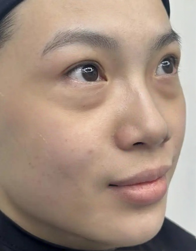 去眼袋手术