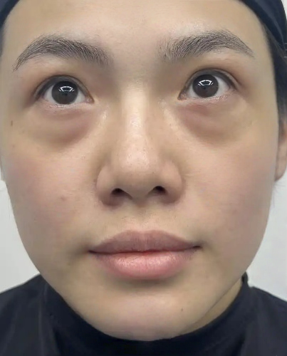 去眼袋手术
