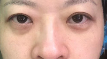 去眼袋手术