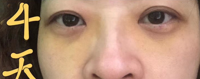去眼袋手术