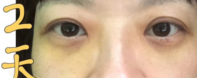 去眼袋手术