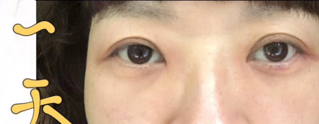 去眼袋手术