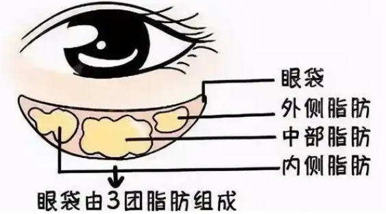 去眼袋手术