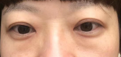 去眼袋手术