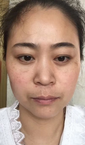 去眼袋手术