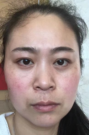 去眼袋手术