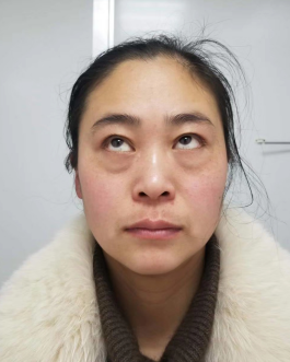 去眼袋手术