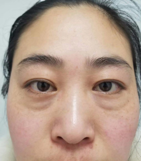 去眼袋手术