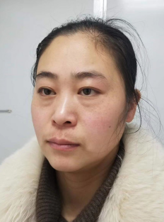 去眼袋手术