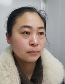 去眼袋手术