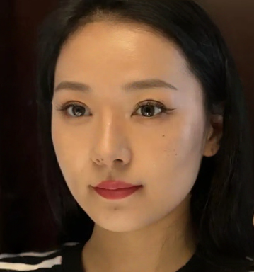 去眼袋手术