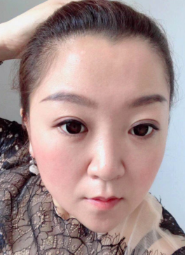 去眼袋手术