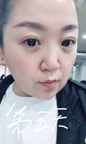 去眼袋手术