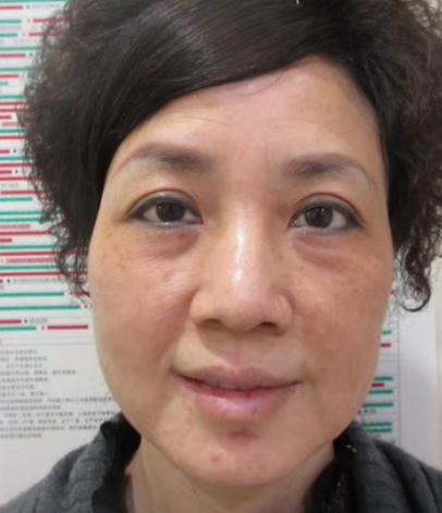 去眼袋手术