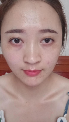 去眼袋手术