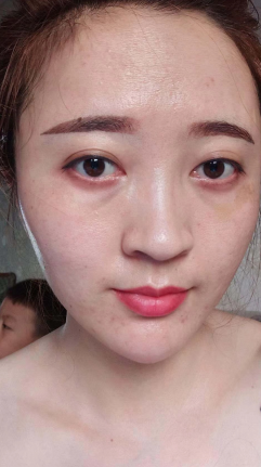 去眼袋手术