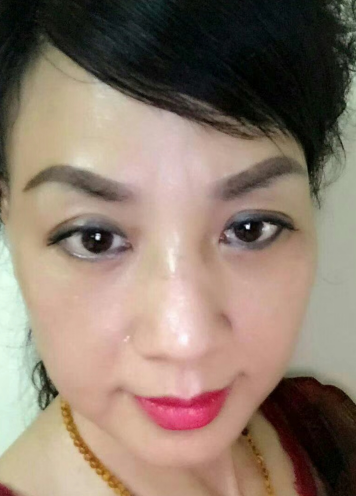 去眼袋手术