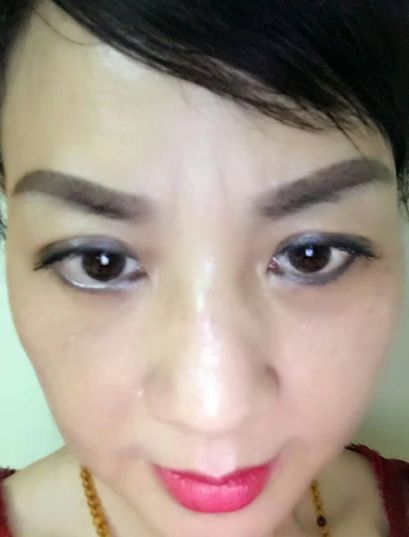 去眼袋手术