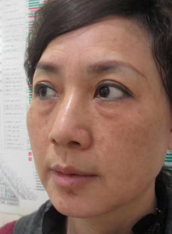 去眼袋手术