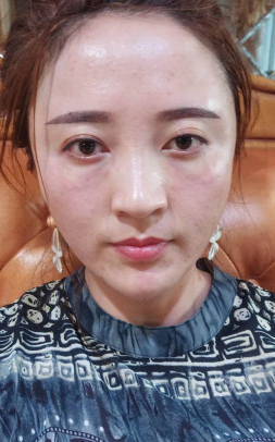 去眼袋手术