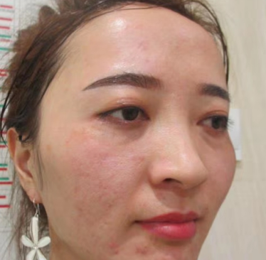 去眼袋手术