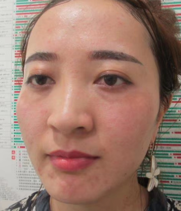 去眼袋手术