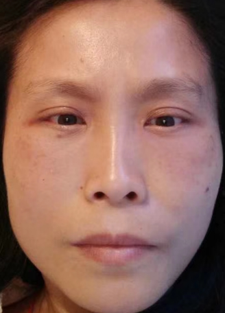 去眼袋手术