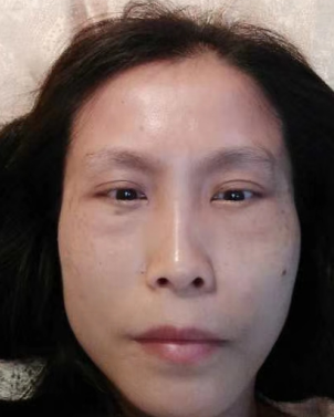 去眼袋手术
