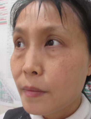 去眼袋手术