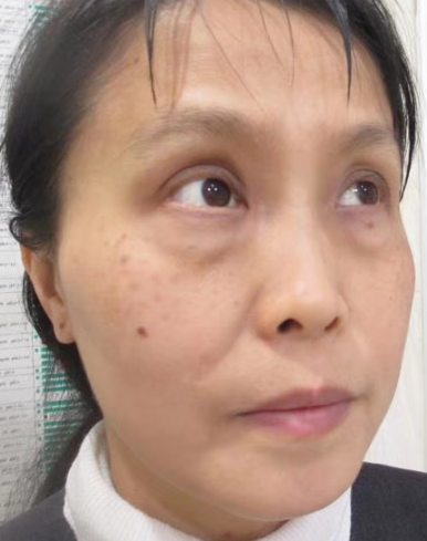去眼袋手术