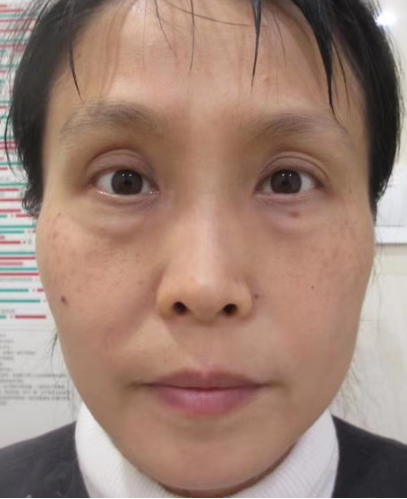 去眼袋手术