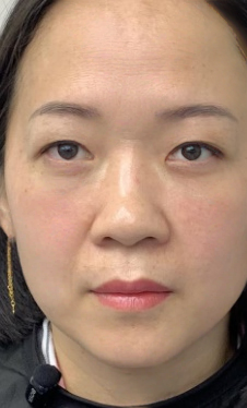 去眼袋手术