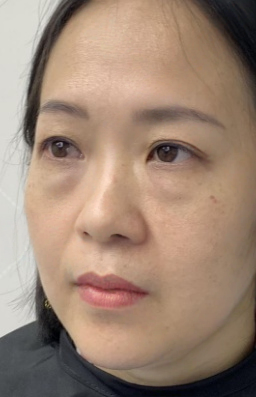 去眼袋手术