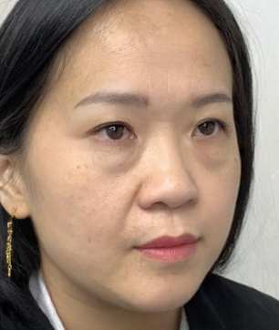 去眼袋手术