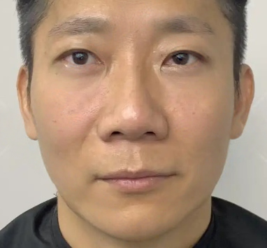 去眼袋手术