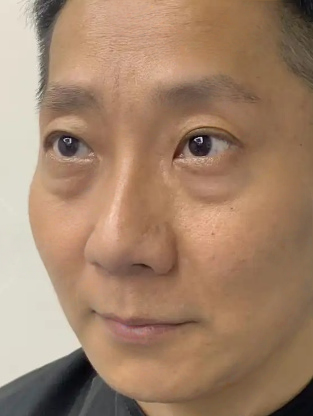 去眼袋手术